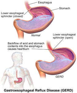 gastroesophageal reflux diseases